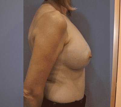 Breast Reconstruction Before & After Gallery - Patient 13574538 - Image 2