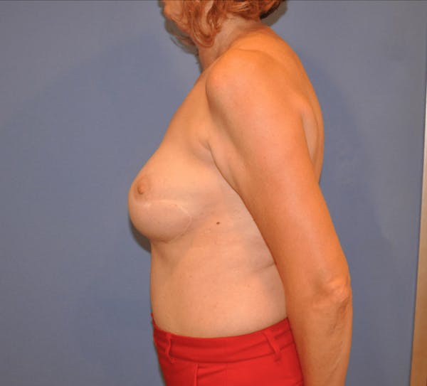 Breast Reconstruction Before & After Gallery - Patient 13574538 - Image 3