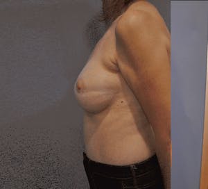 Before and After Breast Reconstruction in Newport Beach