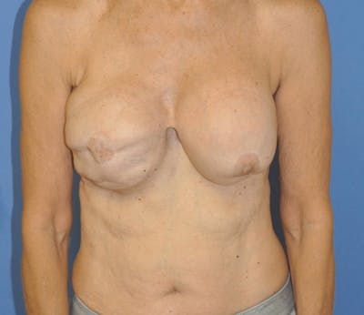 Breast Reconstruction Before & After Gallery - Patient 13574542 - Image 1