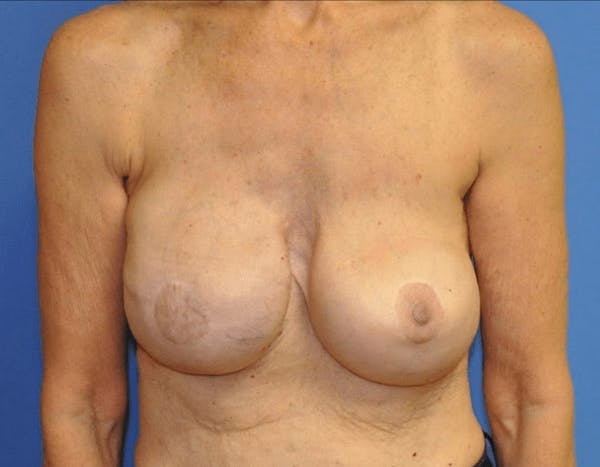 Breast Reconstruction Before & After Gallery - Patient 13574542 - Image 2
