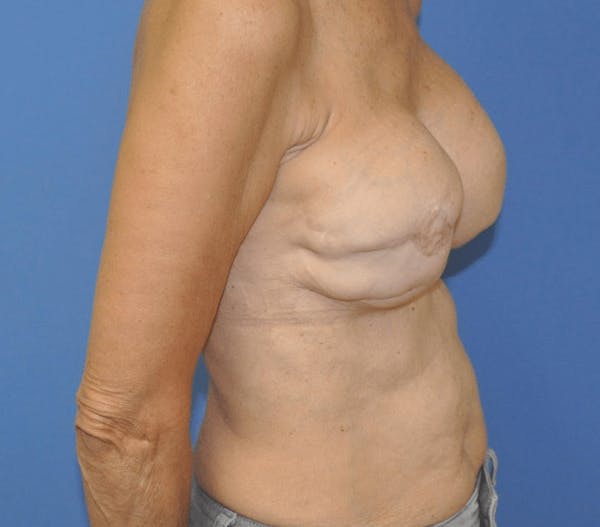 Breast Reconstruction Before & After Gallery - Patient 13574542 - Image 3