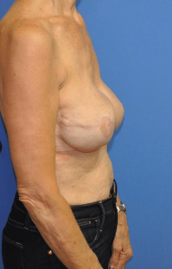 Breast Reconstruction Before & After Gallery - Patient 13574542 - Image 4
