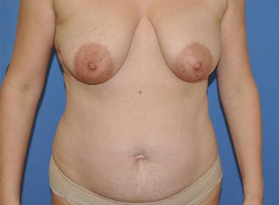 Breast Lift Before & After Gallery - Patient 13574547 - Image 1