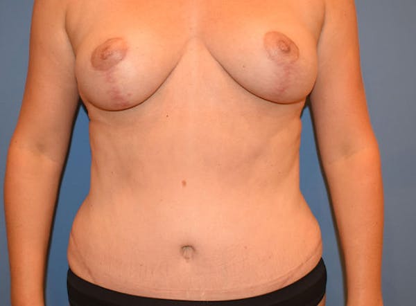 Breast Lift Before & After Gallery - Patient 13574547 - Image 2