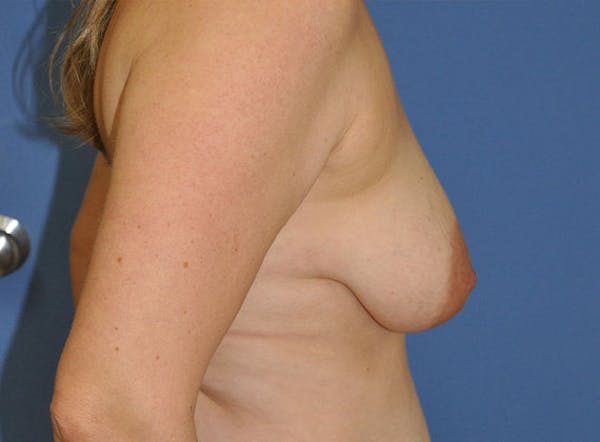 Breast Lift Before & After Gallery - Patient 13574547 - Image 3