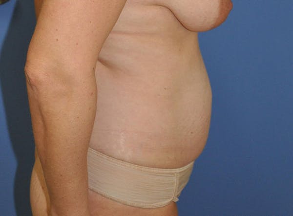 Breast Lift Before & After Gallery - Patient 13574547 - Image 5