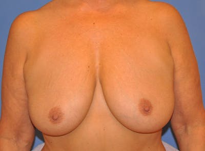 Breast Lift Before & After Gallery - Patient 13574549 - Image 1