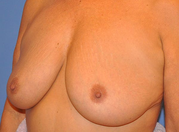 Breast Lift Before & After Gallery - Patient 13574549 - Image 3