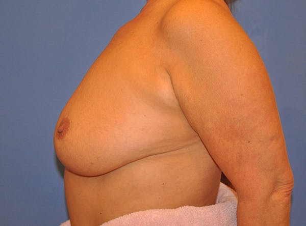 Breast Lift Before & After Gallery - Patient 13574549 - Image 6