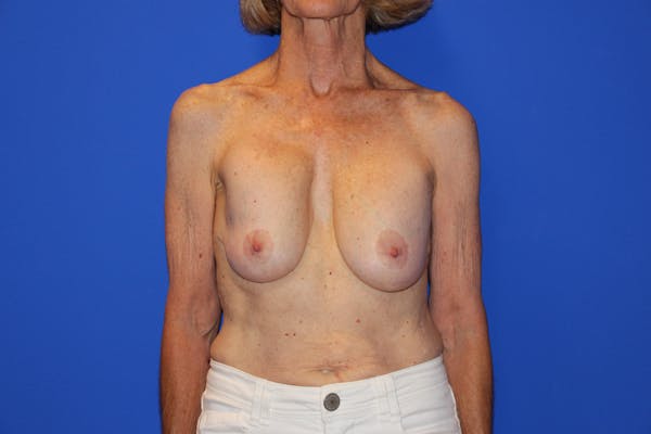 Breast Lift Before & After Gallery - Patient 13574560 - Image 1