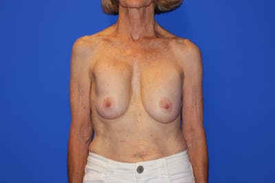 Breast Lift Before & After Gallery - Patient 13574560 - Image 1