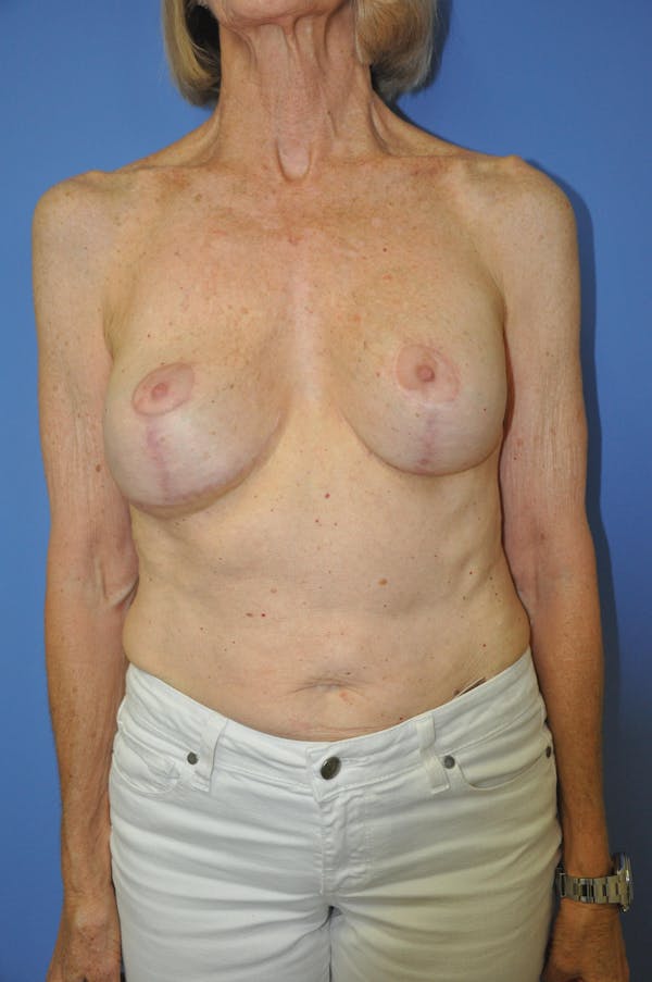 Breast Lift Before & After Gallery - Patient 13574560 - Image 2