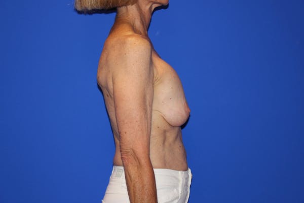 Breast Lift Before & After Gallery - Patient 13574560 - Image 5