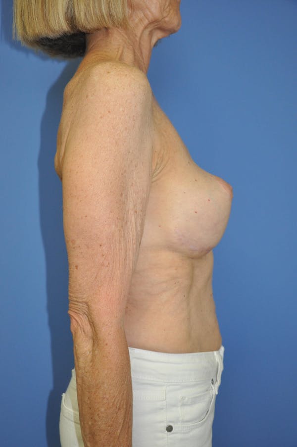 Breast Lift Gallery - Patient 13574560 - Image 6