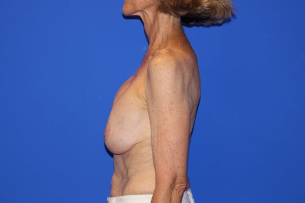 Breast Lift Before & After Gallery - Patient 13574560 - Image 9