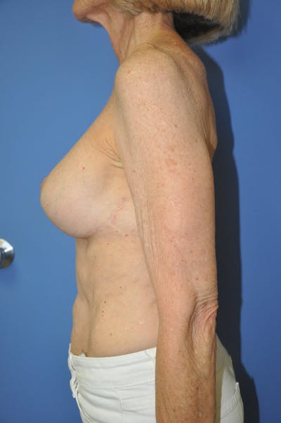 Breast Lift Gallery - Patient 13574560 - Image 10