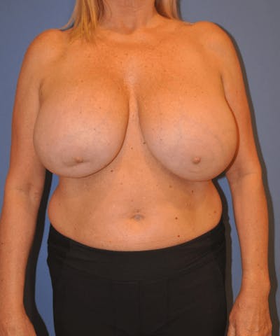 Breast Lift Before & After Gallery - Patient 13574561 - Image 1