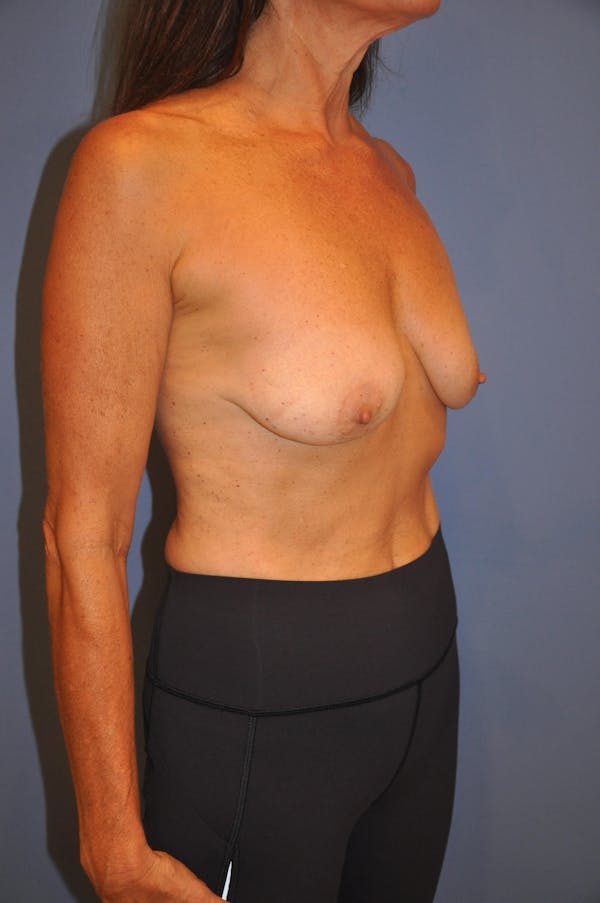 Breast Lift Before & After Gallery - Patient 13574562 - Image 3