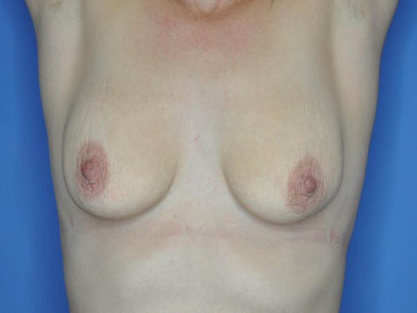 Breast Lift Before & After Gallery - Patient 13574564 - Image 1