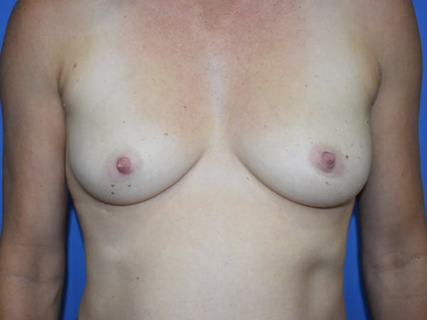 Breast Augmentation Gallery - Patient 13574566 - Image 1