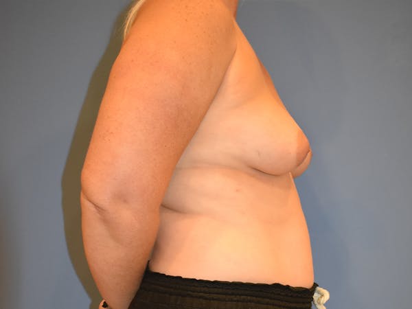 Breast Augmentation Gallery - Patient 13574569 - Image 3