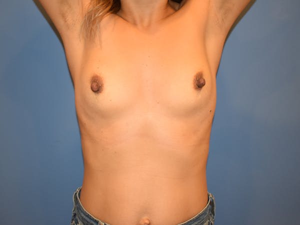 Breast Augmentation Before & After Gallery - Patient 13574570 - Image 3