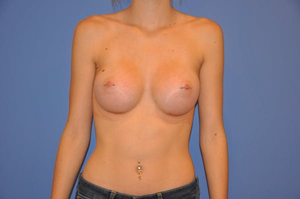 Breast Augmentation Before & After Gallery - Patient 13574579 - Image 2