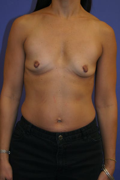 Breast Augmentation Gallery - Patient 13574589 - Image 1