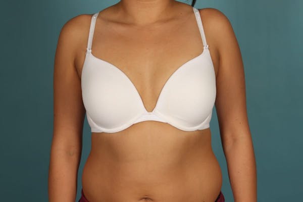 Breast Augmentation Gallery - Patient 13574591 - Image 7