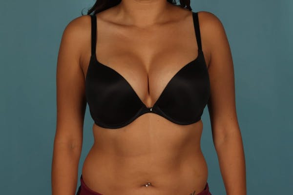 Breast Augmentation Before & After Gallery - Patient 13574591 - Image 8