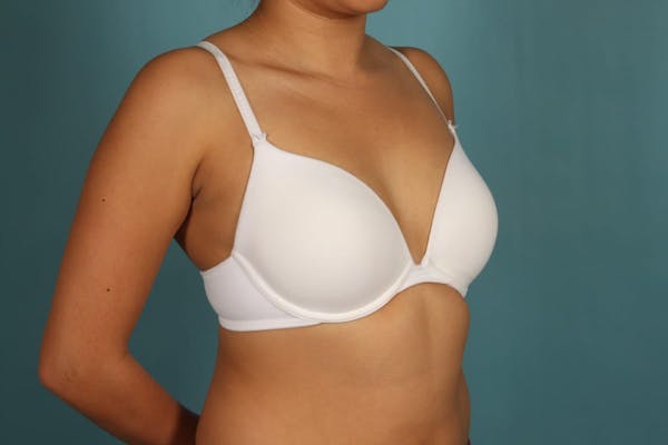 Breast Augmentation Gallery - Patient 13574591 - Image 9