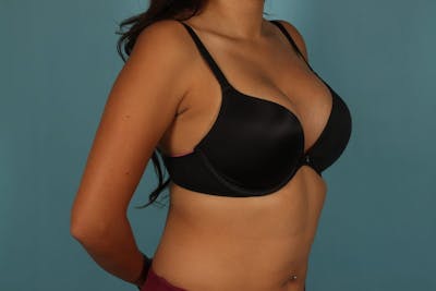 Breast Augmentation Before & After Gallery - Patient 13574591 - Image 10