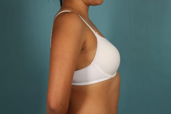 Breast Augmentation Gallery - Patient 13574591 - Image 11