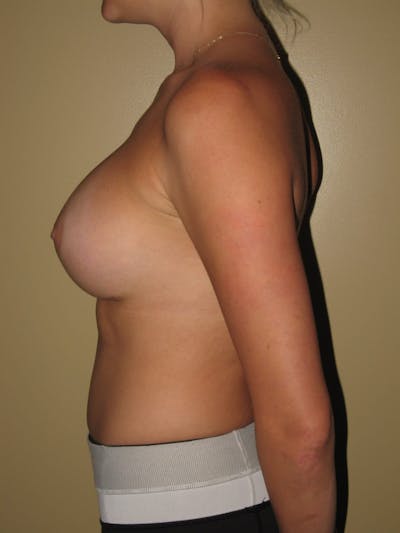Breast Augmentation Before & After Gallery - Patient 13574596 - Image 6