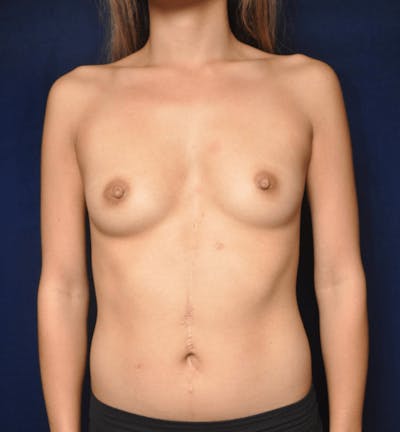Breast Augmentation Before & After Gallery - Patient 13574597 - Image 1