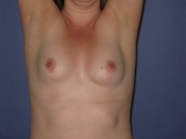Breast Augmentation Before & After Gallery - Patient 13574610 - Image 3