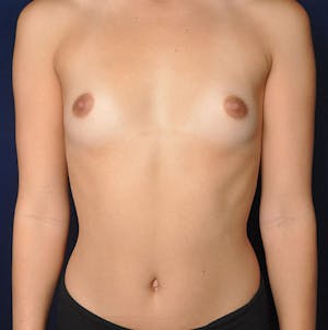 Before and After Breast Implants in Newport Beach