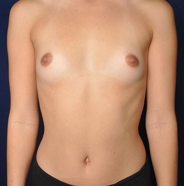 Breast Augmentation Before & After Gallery - Patient 13574614 - Image 1