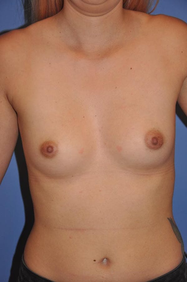 Breast Augmentation Before & After Gallery - Patient 13574616 - Image 1