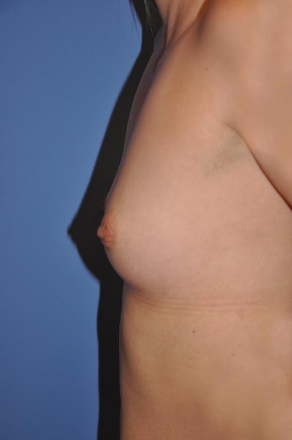 Breast Augmentation Before & After Gallery - Patient 13574616 - Image 3