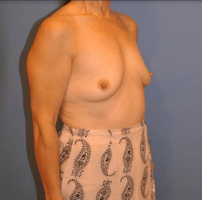 Breast Augmentation Before & After Gallery - Patient 13574621 - Image 1