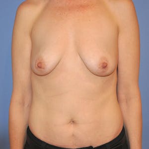 Before and After Breast Augmentation in Newport Beach