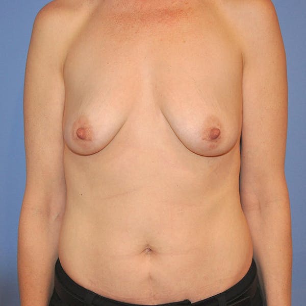 Breast Augmentation Before & After Gallery - Patient 13574624 - Image 1