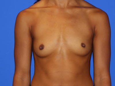 Breast Augmentation Before & After Gallery - Patient 13574627 - Image 1