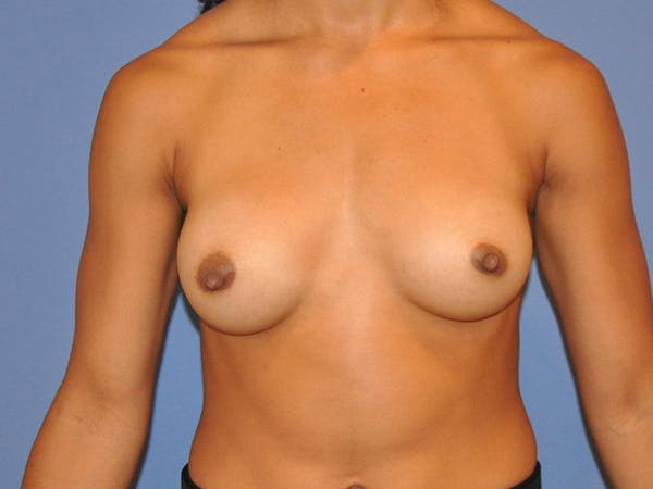 Breast Augmentation Before & After Gallery - Patient 13574627 - Image 2