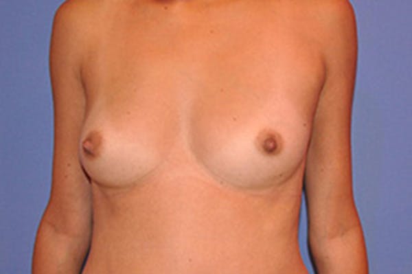 Breast Augmentation Gallery - Patient 13574629 - Image 1
