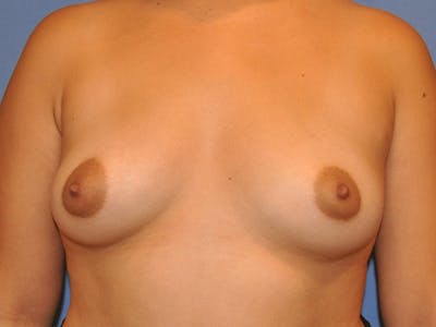 Breast Augmentation Before & After Gallery - Patient 13574630 - Image 1