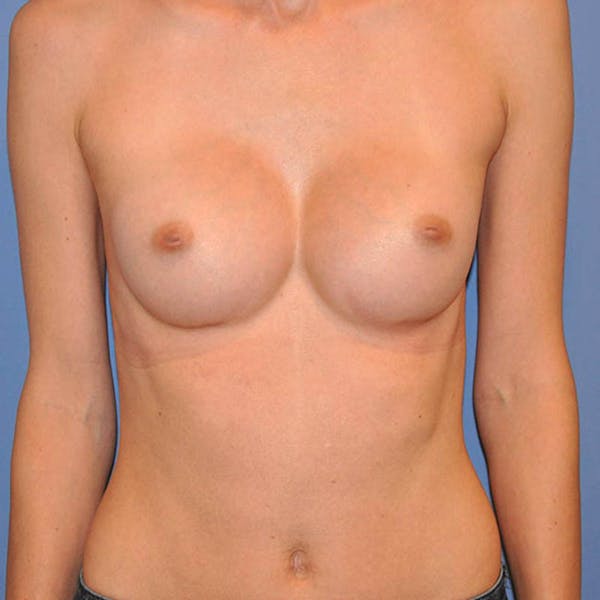 Breast Augmentation Before & After Gallery - Patient 13574632 - Image 2