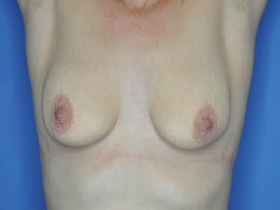 Breast Augmentation Before & After Gallery - Patient 13574637 - Image 1